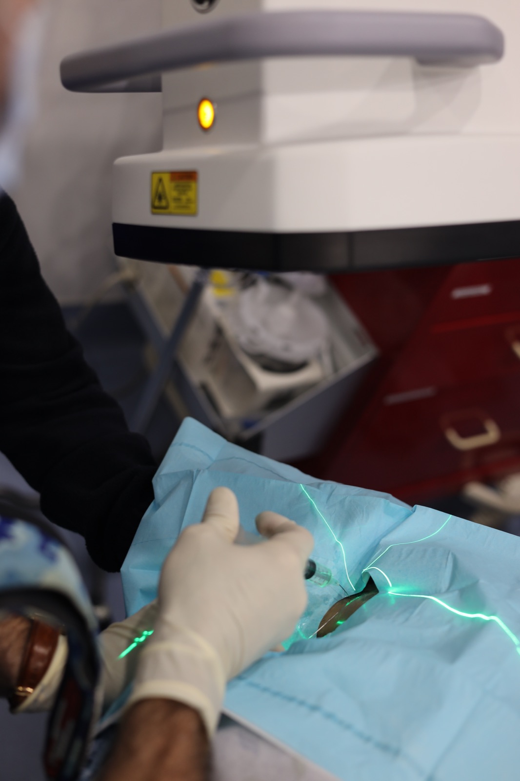 Laser vein treatment being performed