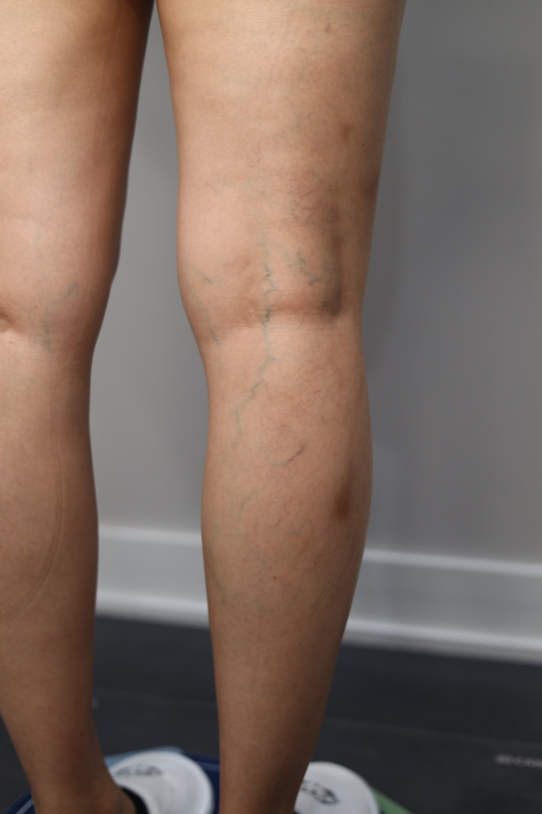 Varicose veins on the back of a patient's legs